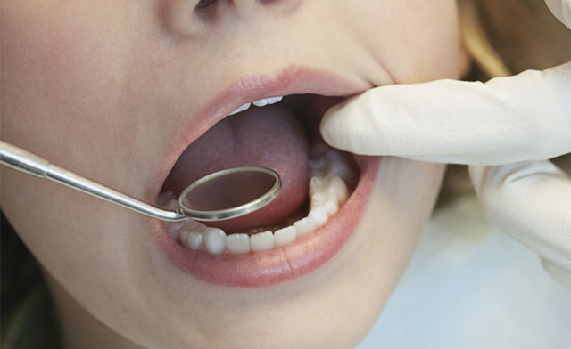 8 Simple Ways to Prevent Tooth Decay