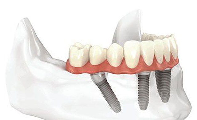 All On 4 Implant