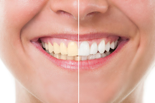Professional Teeth Whitening Cost in Turkey