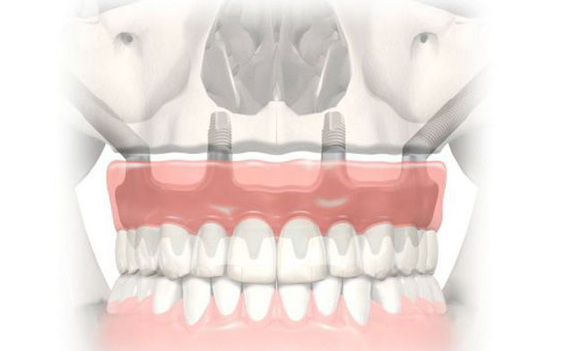 Zygoma Implant