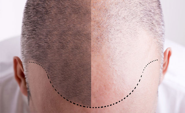 Hair Transplantation