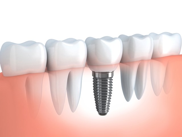 Implant Treatments