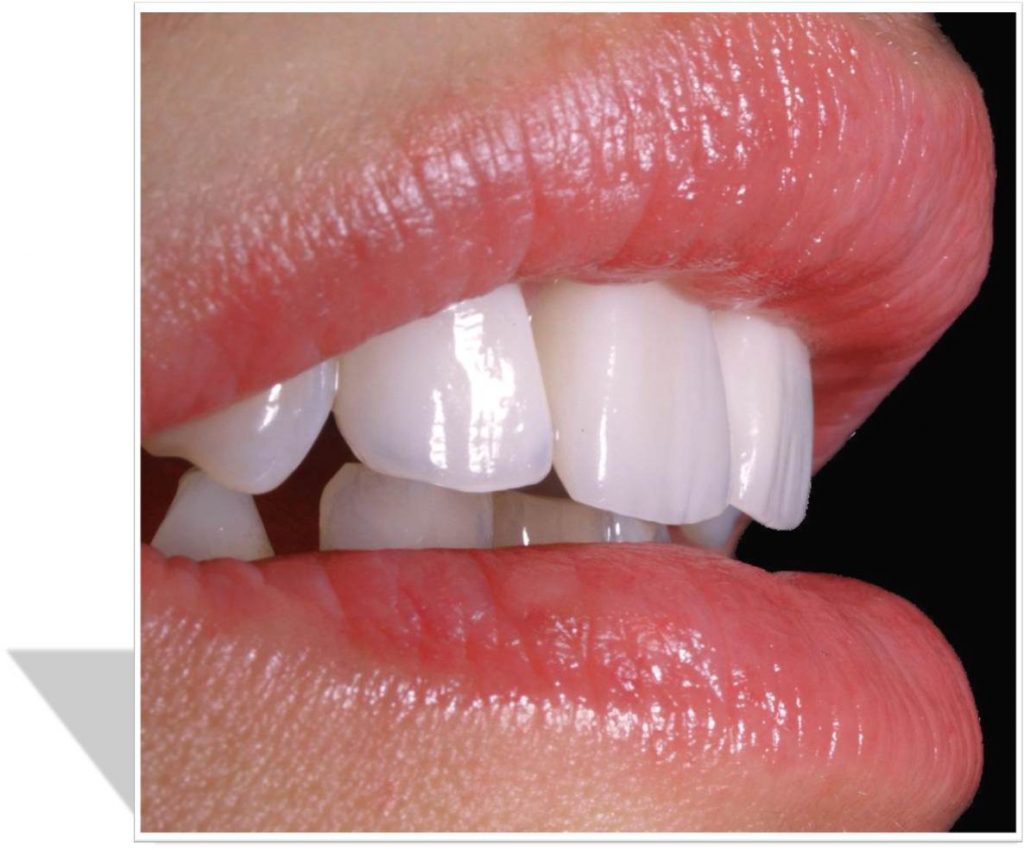 PORCELAIN VENEERS